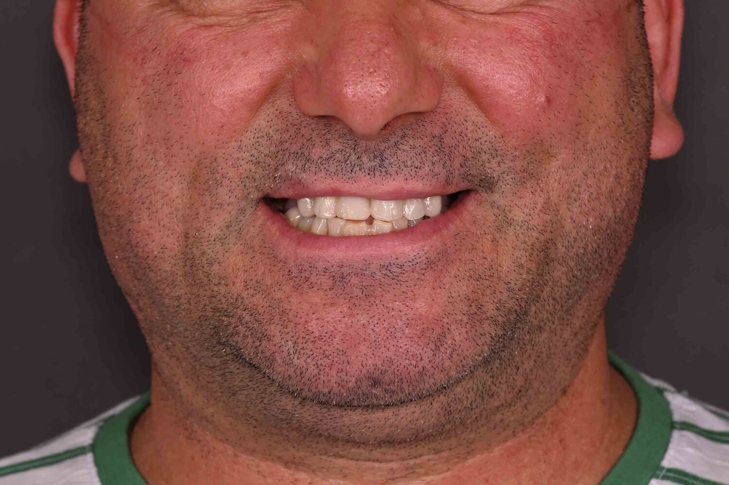 Pacient Clinica Dr. Alin Odor - Rezultat Implantologie